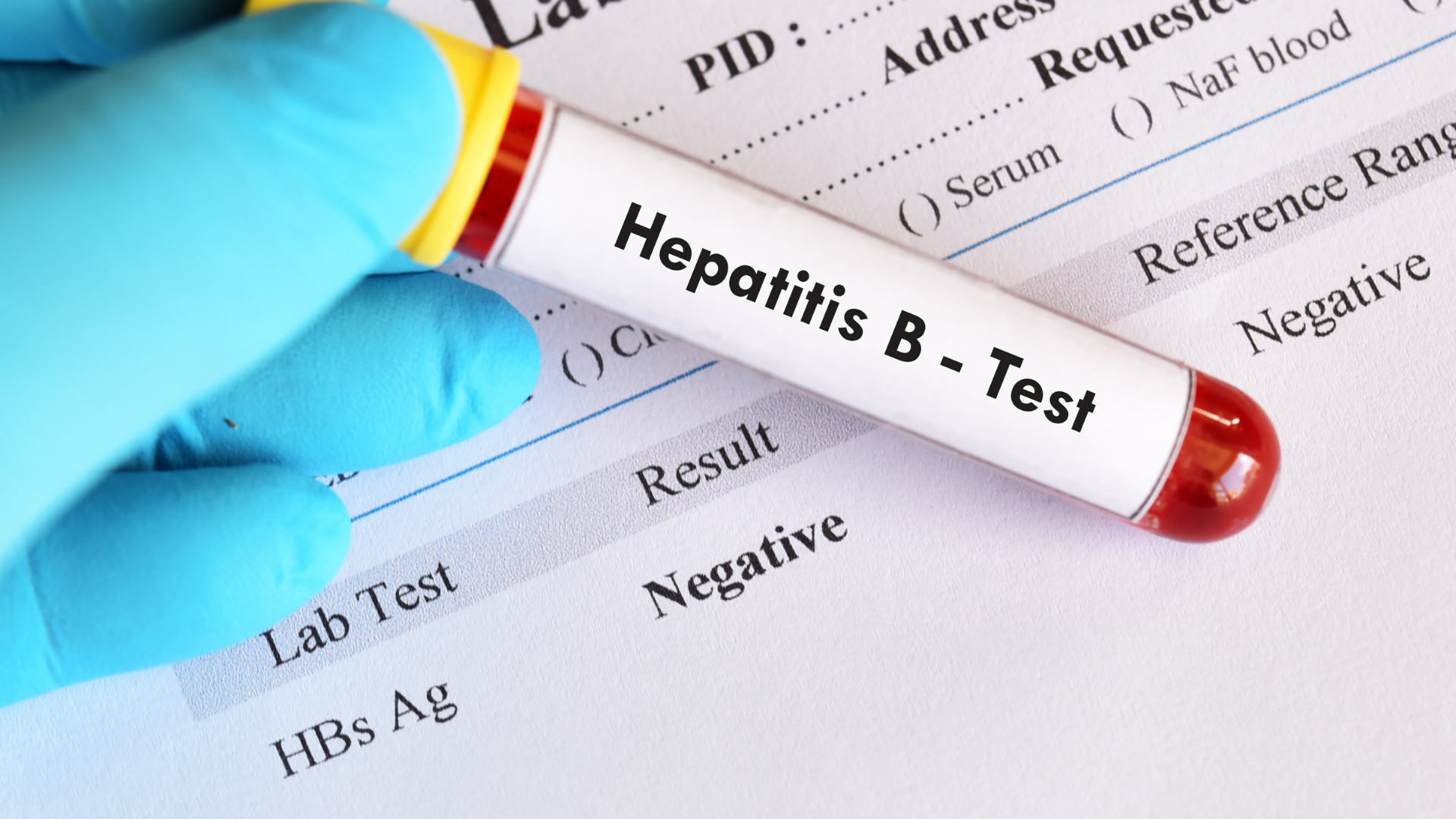 Amostra de sangue com teste de Hepatite B